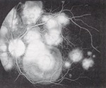 What is Epitheliopathy?