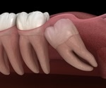 Paracetamol for pain relief after surgical removal of lower wisdom teeth