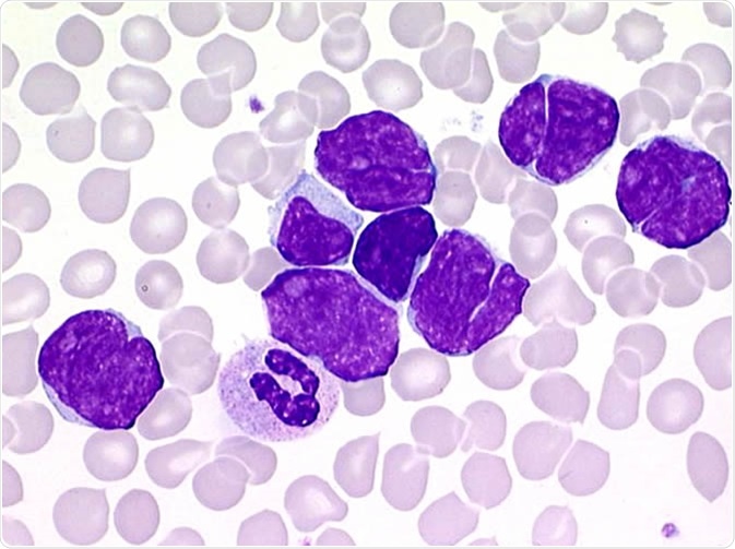 Sézary cells