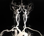 Deep-Vein Thrombosis (DVT) Symptoms and Diagnosis
