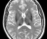 What is Aceruloplasminemia?