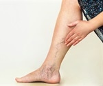 Study links cold hypersensitivity and heaviness in legs to varicose veins