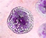 What is AIDS-Related Lymphoma?