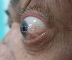 What is Exophthalmos?