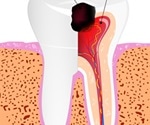 What is Pulpitis?