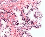 Scoring and Digital Image Analysis of Estrogen Receptor β2 Immunohistochemistry in Prostate Cancer