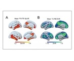 Sleep patterns can predict Alzheimer’s pathology later in life