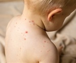 Tribal health officials work to fill vaccination gaps as measles outbreak spreads