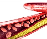 Research shows that intense high dose cholesterol lowering drugs result in a major reduction in deaths and severe heart attacks