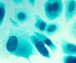 New research may help treatment of Norrie disease and familial exudative vitreoretinopathy (FEVR)