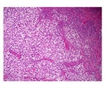 Study finds no increased risk of congenital anomalies in children of fathers treated for testicular cancer