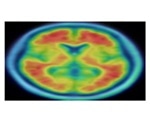 Smarter, more educated people get a cognitive 'head start', but aren't protected from Alzheimer's
