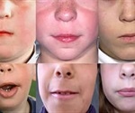 Aarskog Syndrome Causes and Diagnosis