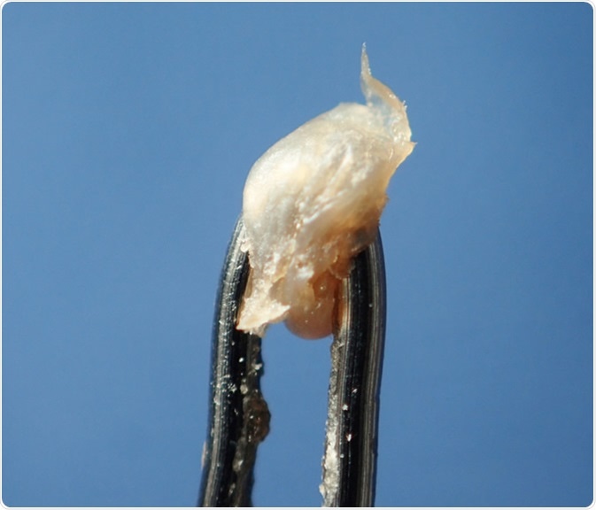 Earwax on the needle tip. Nickel_Bell / Shutterstock