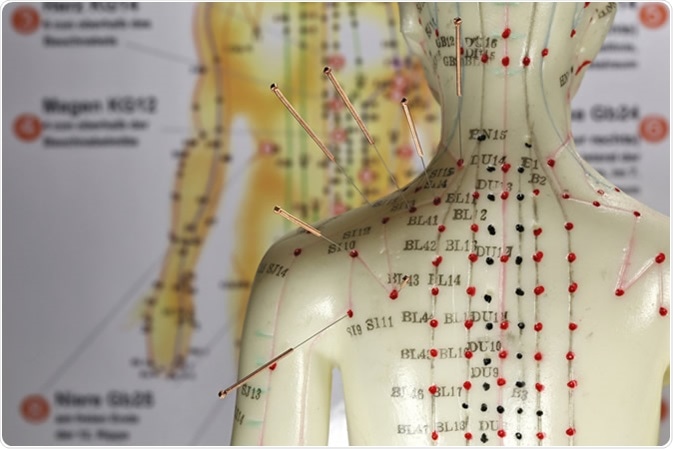 Female acupuncture model with needles in the shoulder - Image Credit: Bjoern Wylezich / Shutterstock