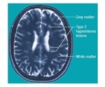 Multiple Sclerosis Neurobiology and Therapeutic Strategies