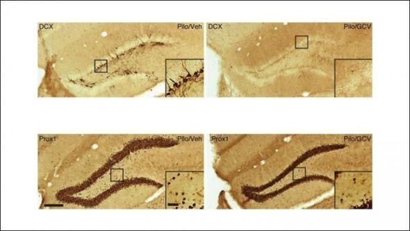 Removing newborn neurons after brain injury reduces seizures in mice