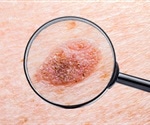 Immunocompromised people are susceptible to skin cancer caused directly by beta-HPV