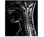 Johns Hopkins co-leads study on 'poliolike' condition affecting children