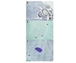 Scientists study immune molecules inside mycetoma grains