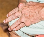 Pseudogout versus Gout