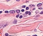 New study provides a better understanding of Merkel cell carcinoma