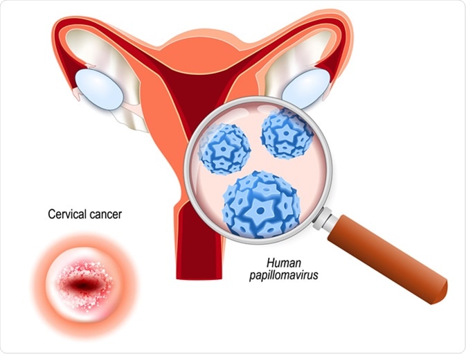 Cervical Cancer. Carcinoma is Malignant neoplasm arising from cells in the cervix uteri. Close-up of Human papillomavirus infection (HPV). cut-away view of the uterus and cervix that viewed from below. Image Credit: Designua / Shutterstock