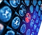 MRI scans show how ADHD medication affects brain structure in children