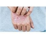 Johns Hopkins researchers estimate real-world prevalence of prurigo nodularis