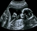 Winter babies at 'higher risk of mental health disorders'