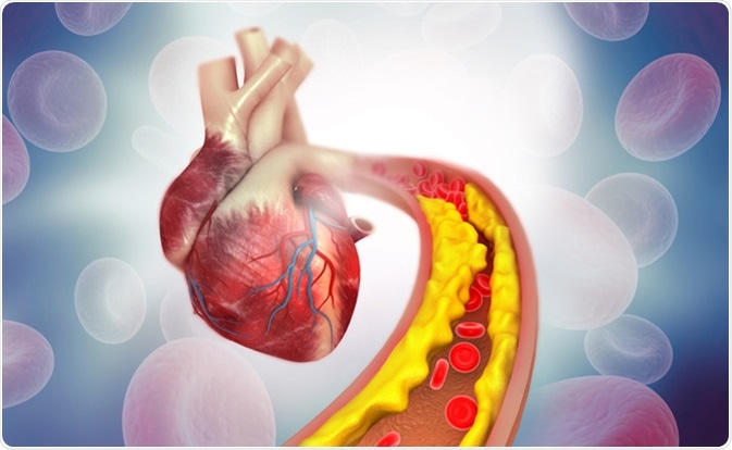 Cholesterol plaque in artery with human heart anatomy. Image Credit: Explode / Shutterstock