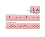 Arrhythmia Cardiovascular Research