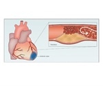 Myocardial Infarction Cardiovascular Research