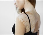 Researchers discover vitiligo gene
