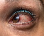 Pilocarpine eye drops improve outcomes after Kahook Dual Blade goniotomy surgery