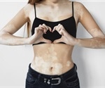 Vitiligo gene linked to other autoimmune diseases