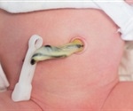Ultrasound technique enhances decision making for reduced fetal movement