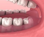 No wisdom in pulling wisdom teeth