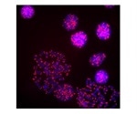 Gene coding error likely responsible for rare form of inherited 'short telomere' disease