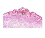 Johns Hopkins researchers link a gene to melanoma growth and spread