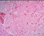 Brain tumors hijack healthy neurons in order to grow