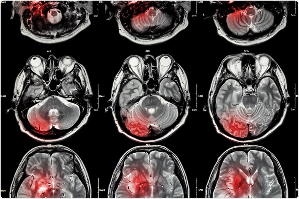 MRI of the brain