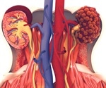 Promising new drug being developed for polycystic kidney disease