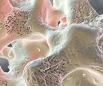 Taking Calcium and Vitamin D for Osteoporosis