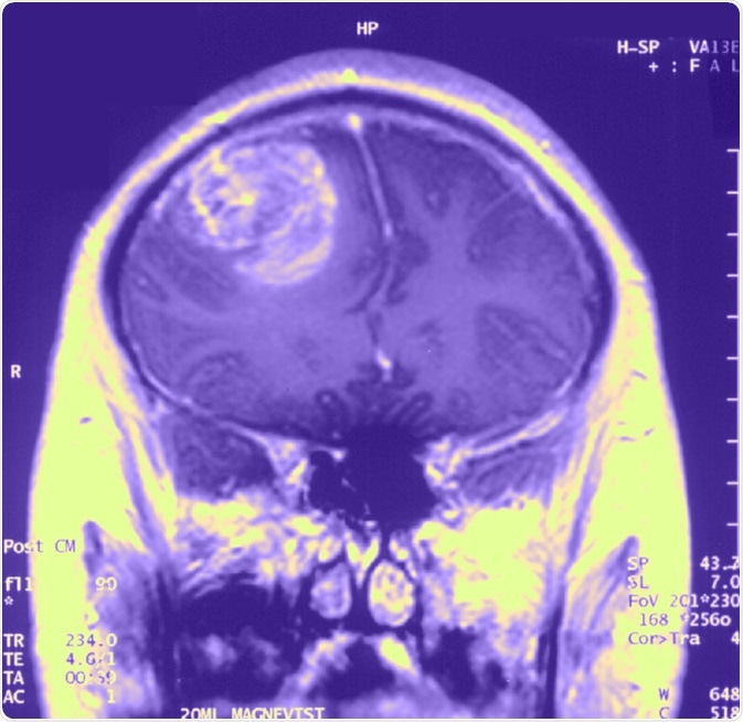 Gliobastoma (astrocytoma) WHO grade IV - MRI coronal view, post contrast. 15 year old boy. image Credit: Christaras A