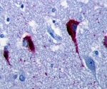 The Role of Tau Aggregation and Alzheimer’s Disease