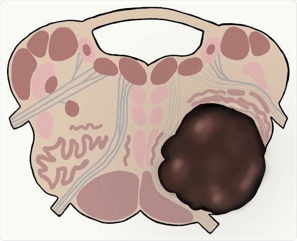 Surgical removal of tumor may boost survival of patients with brainstem high-grade gliomas