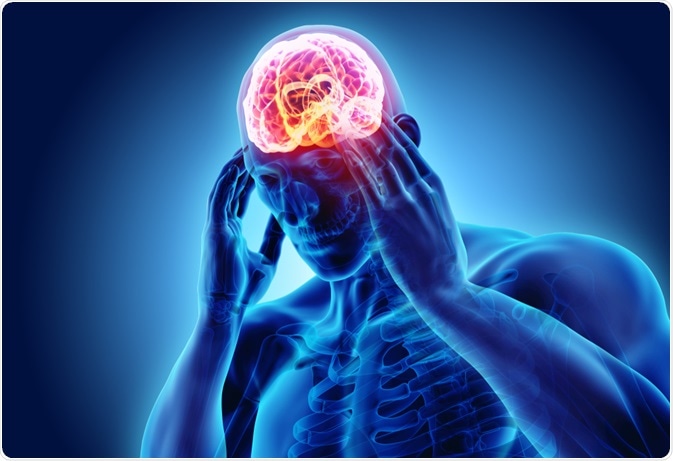 Migraine Migraine