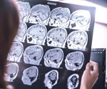 Dementia patients being admitted to hospital for emergencies up by 35 percent