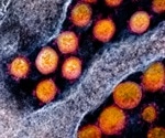Severe COVID-19 linked to age, body mass index and ABO blood group